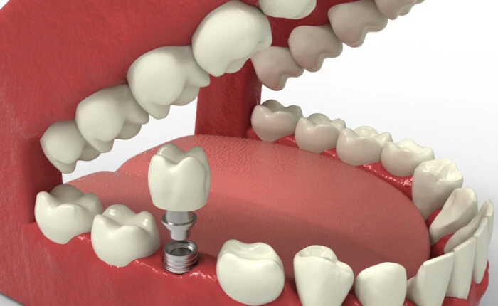 implanty zębowe 02